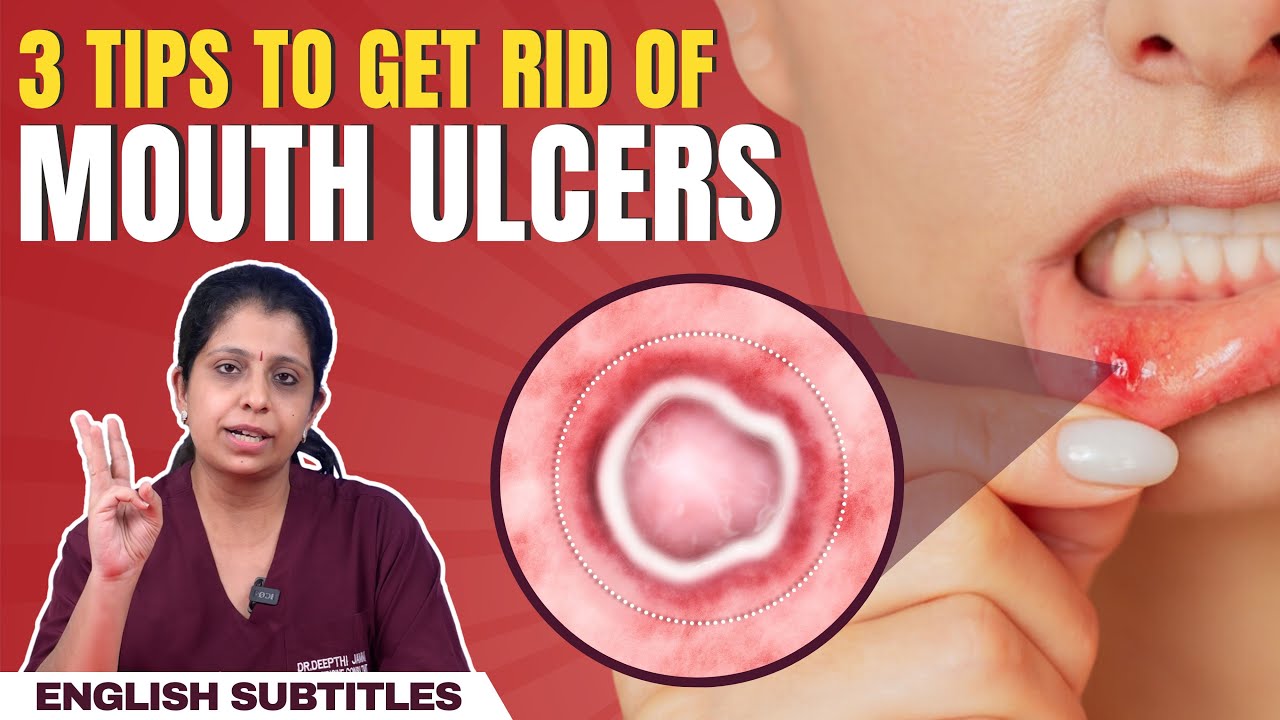 Quick relief from mouth ulcers | வாய்ப்புண் விரைவில் குணமாக இதை செய்யுங்கள்!