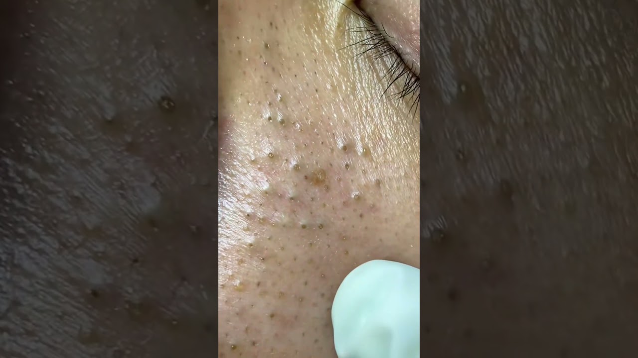 Da dầu nhờn da mụn đầu đen-lỗ ch&acirc;n l&ocirc;ng to? #tranhoa #skincare  #lamdep  #muntrungca