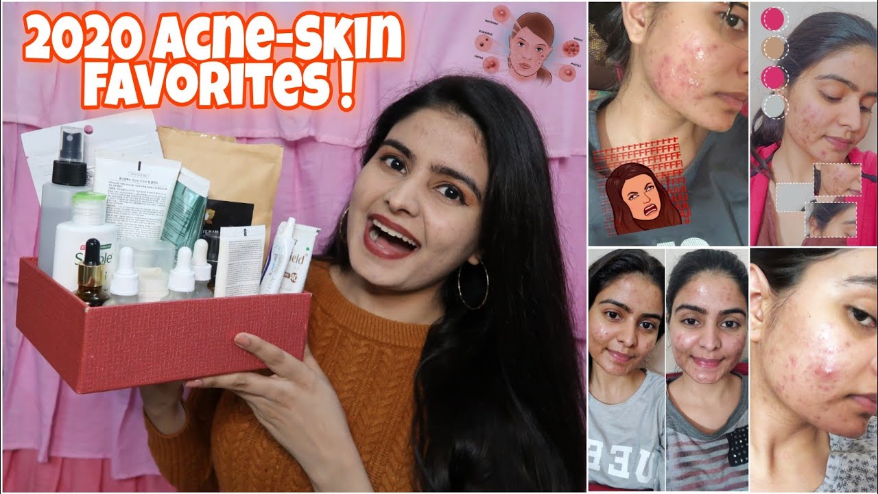 BEST OF ACNE SKIN 2020 |  Pustules/Acne Marks/Oily Skin | Kashika Chauhan