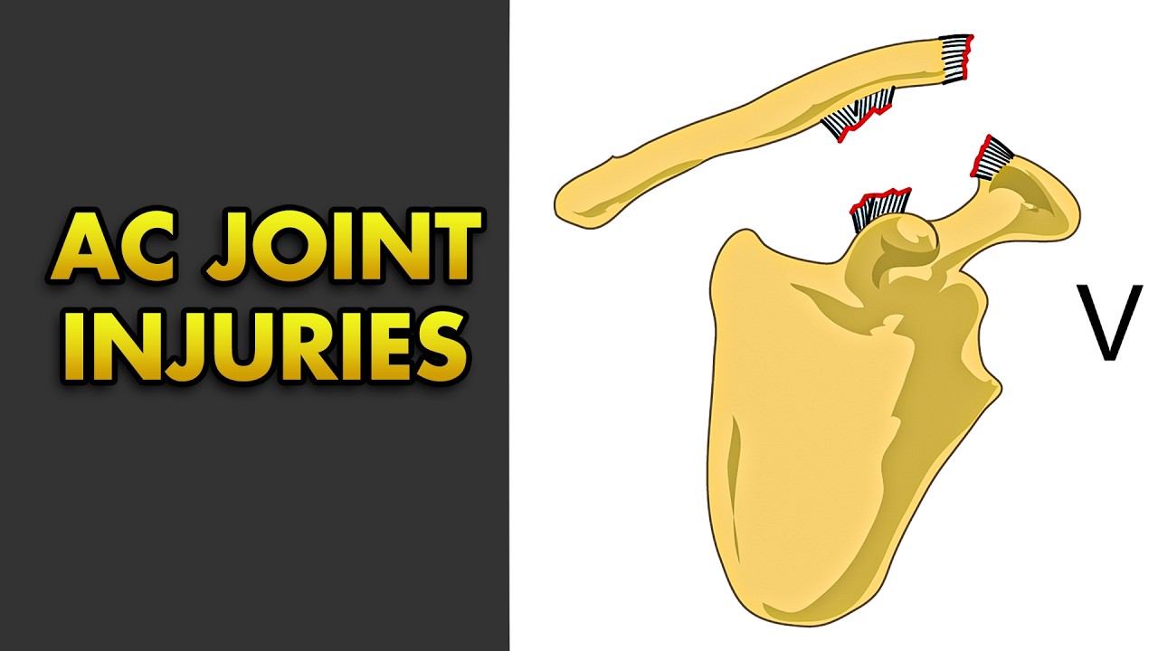 Acromioclavicular Joint Injury: Rockwood Classification, Clinical Features and Treatment