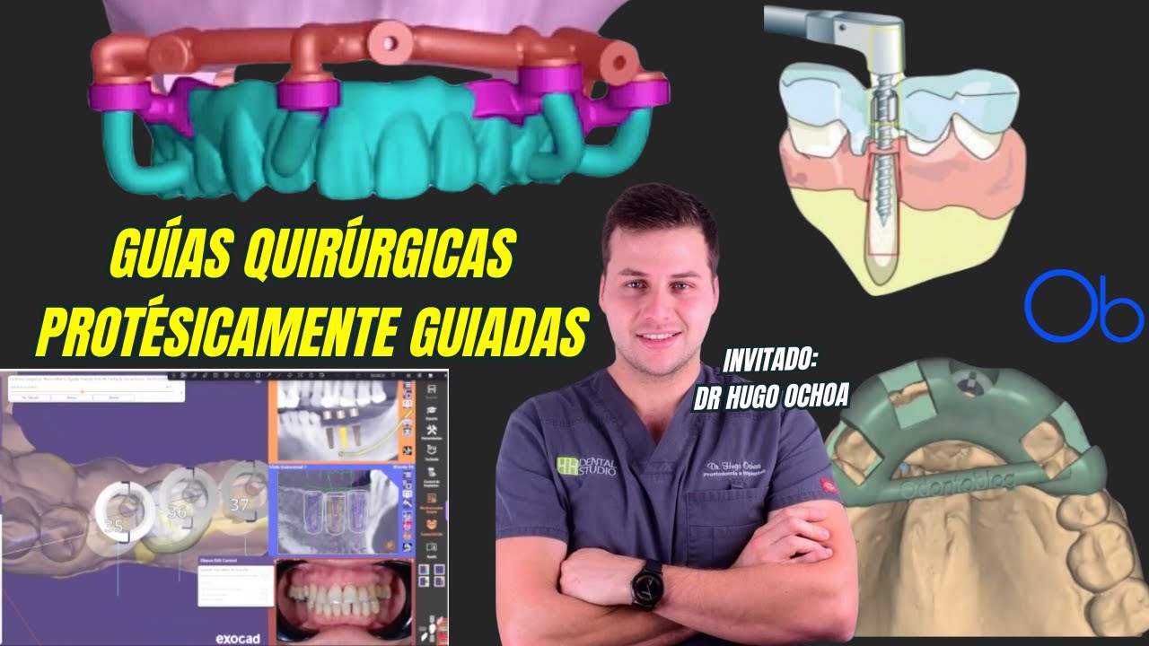 Guías Quirúrgicas Protésicamente Guiadas con carga inmediata con Dr Hugo Ochoa