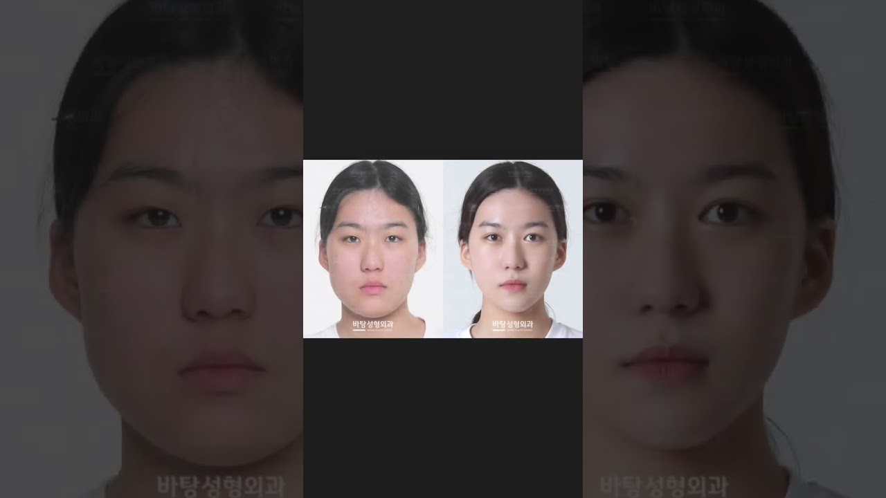 #plasticsurgery #facialcontour #southkorea To complete the natural and pretty V-line