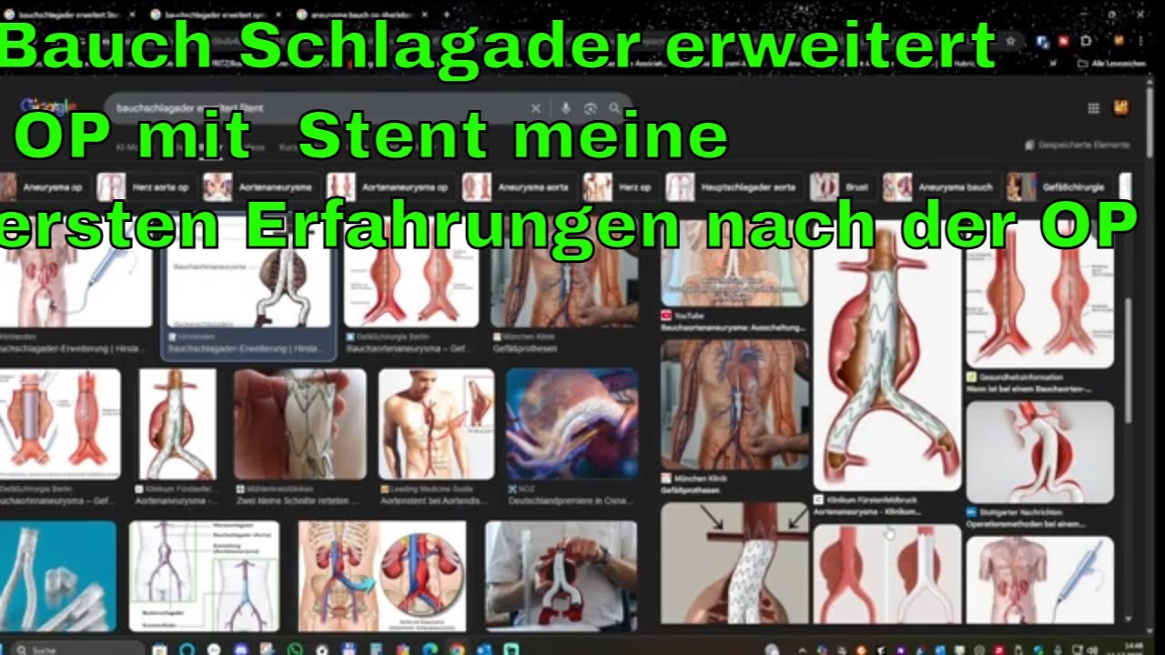 Bauch Schlagader erweitert OP mit  Stent meine ersten Erfahrungen nach der OP