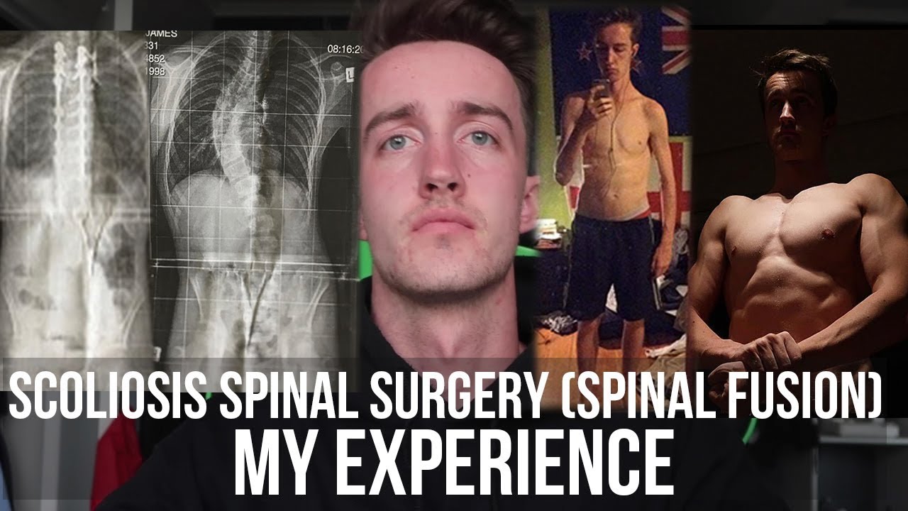 Scoliosis Surgery 7 years later || My experience and advice. [Spinal Fusion]