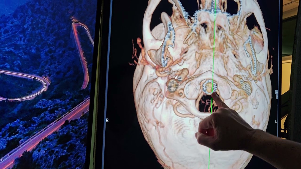 Cervical and Thoracic Syrinx