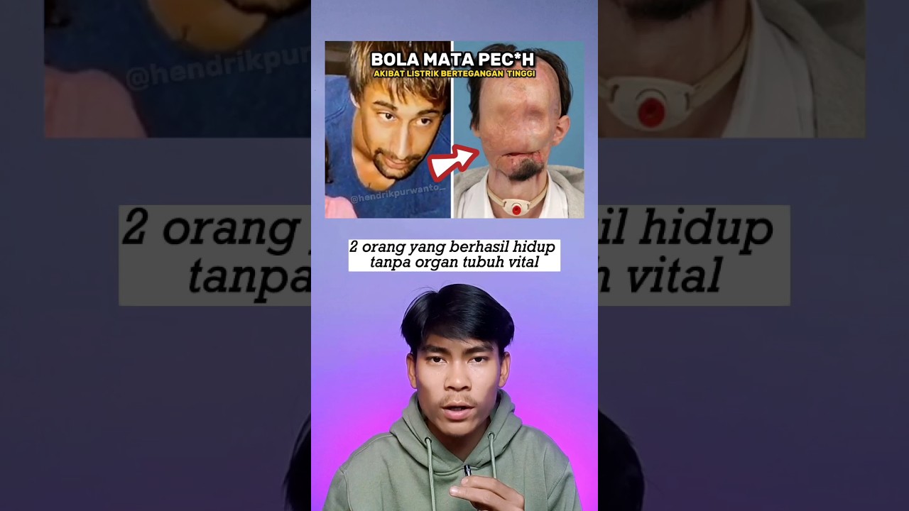 2 Orang yang Berhasil Hidup Tanpa Organ Tubuh Vital #shorts