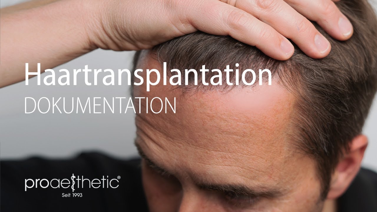 Haartransplantation | Erfahrungsbericht | proaesthetic Heidelberg