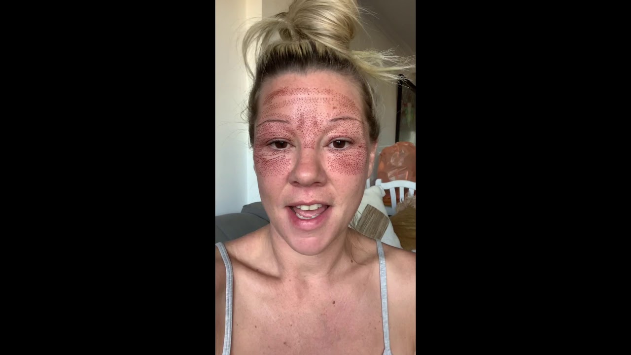 Fibroblast Treatment - Before & After vídeo diary