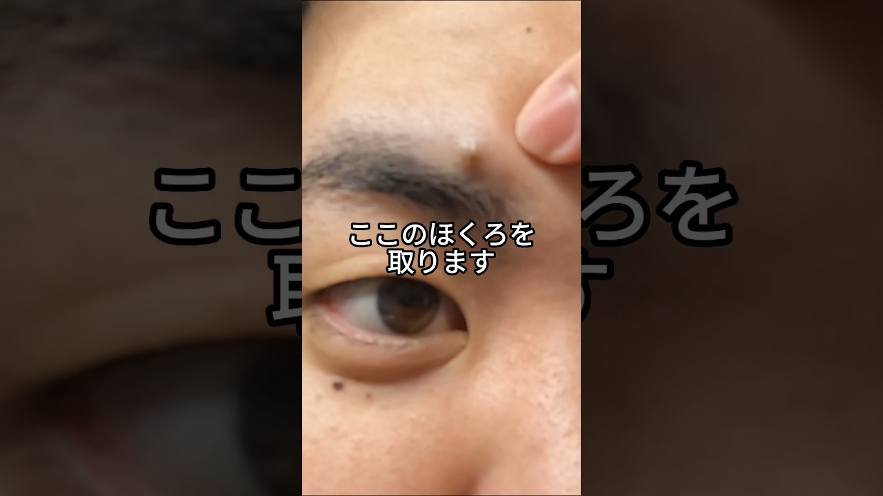 ほくろ除去から1ヶ月を1分でまとめた