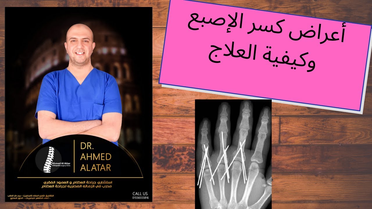 أعراض كسر الإصبع وكيفية العلاج - د احمد العطار