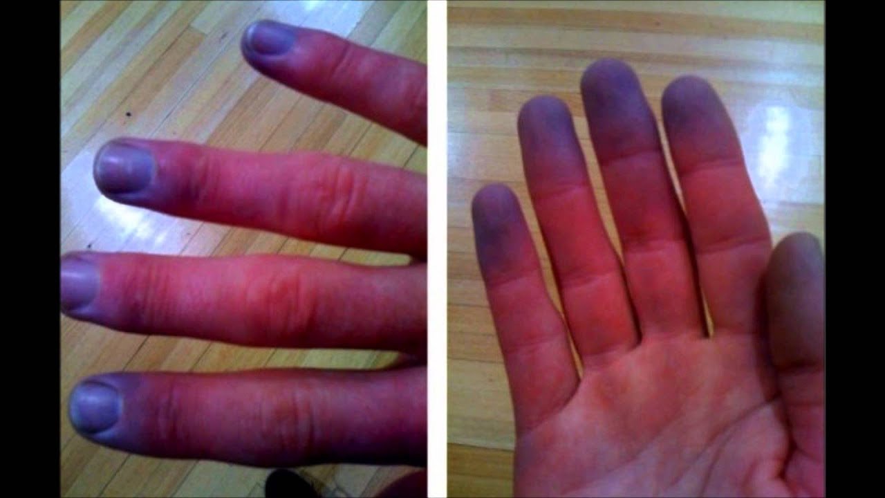 Fenomeno di Raynaud alle mani legato al freddo: sintomi, cause, cura