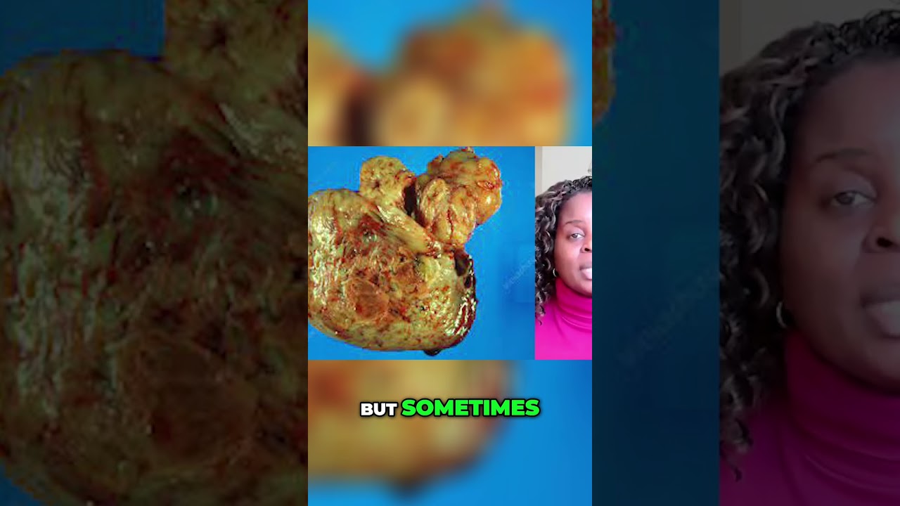 Fibroids vs Uterine Sarcoma Which One Is More Dangerous?
