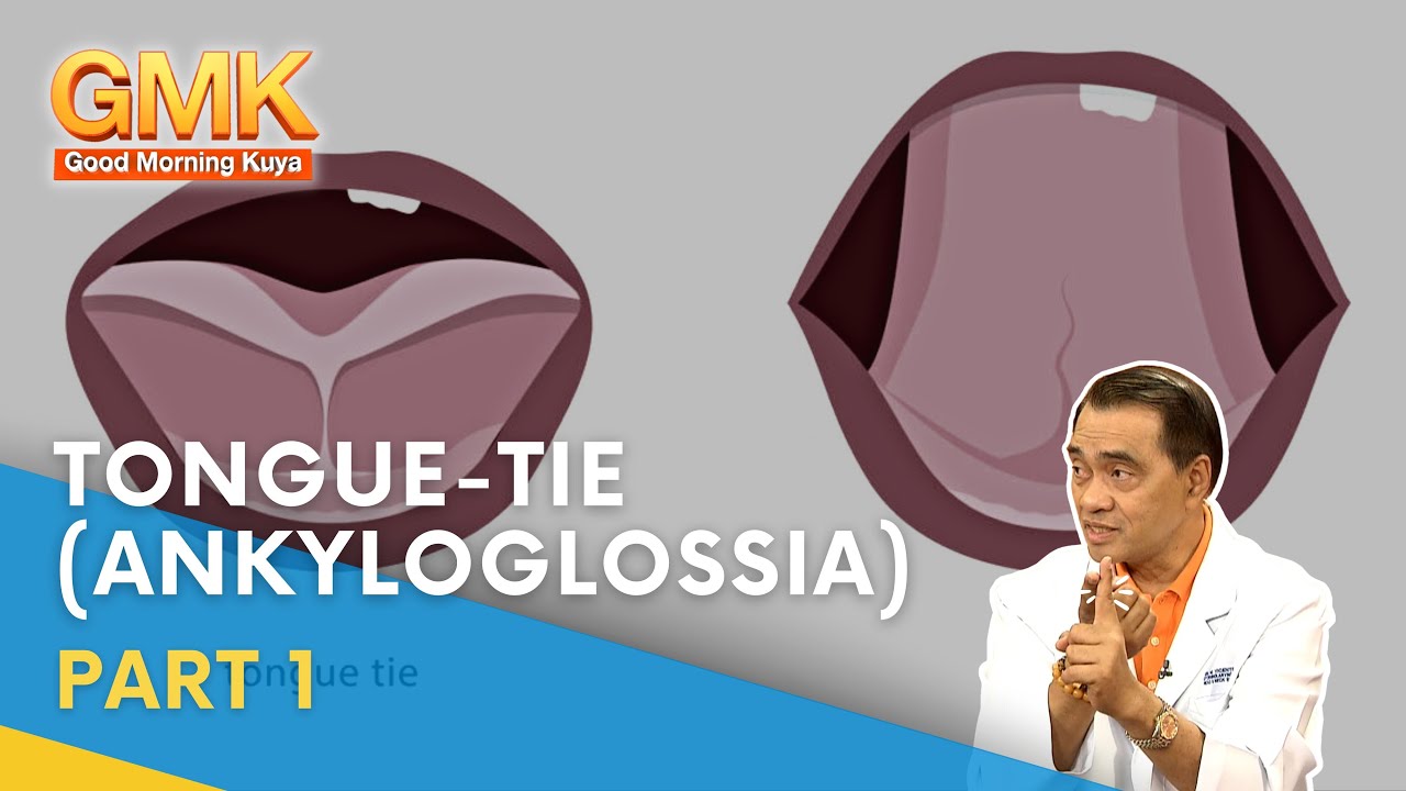 Tongue-Tie (Ankyloglossia) Part 1 | Usapang Pangkalusugan