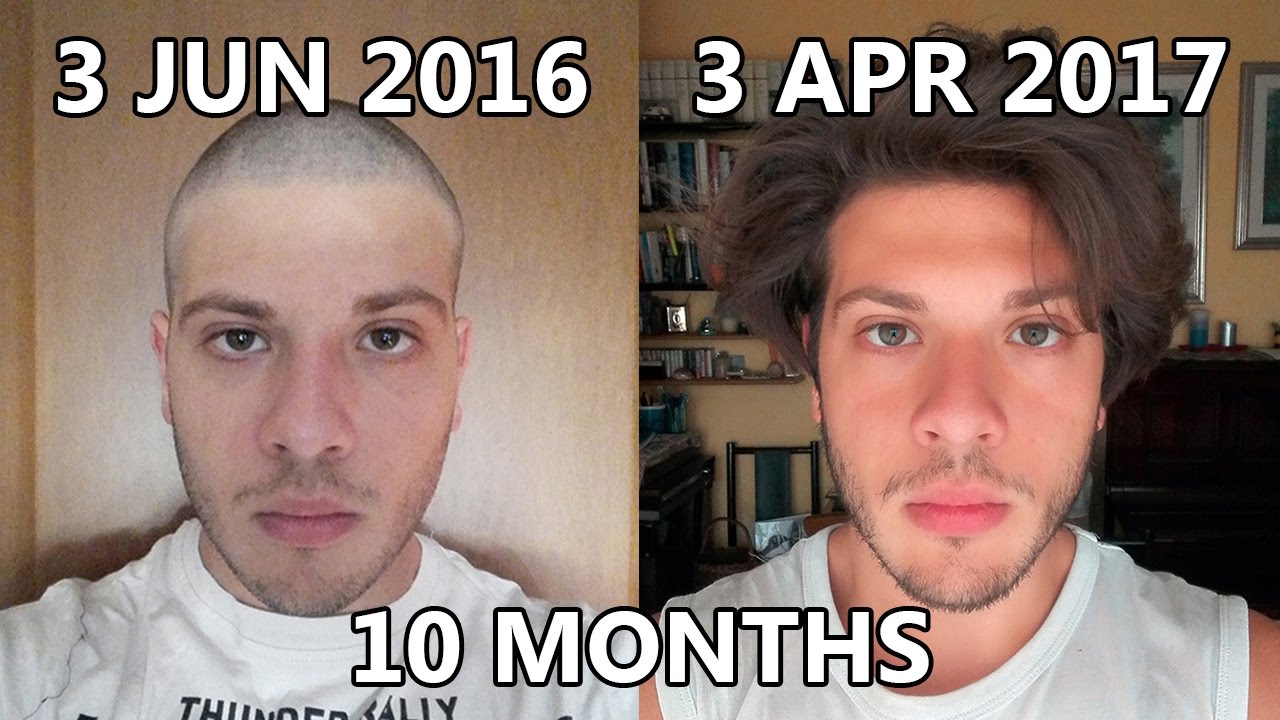 Top Hair Growth Time Lapse - 10 Months