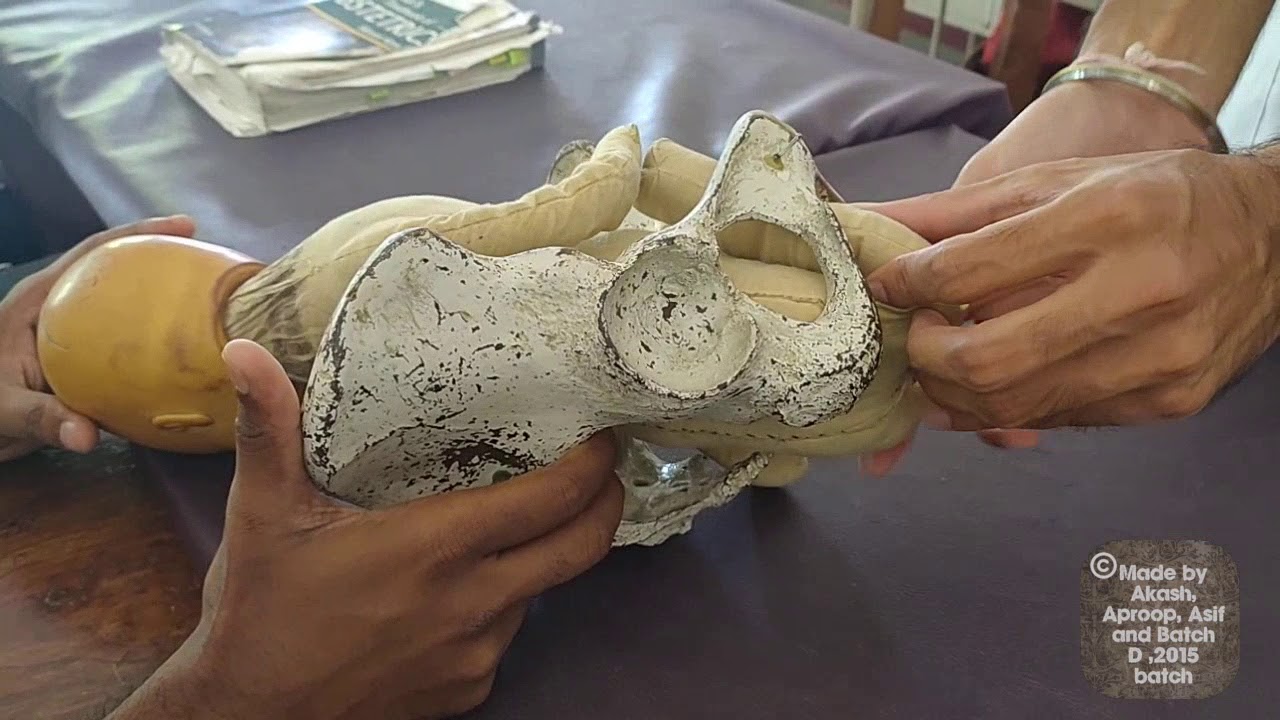 Pinard's method of complicated breech delivery | Obstetrics| medicine