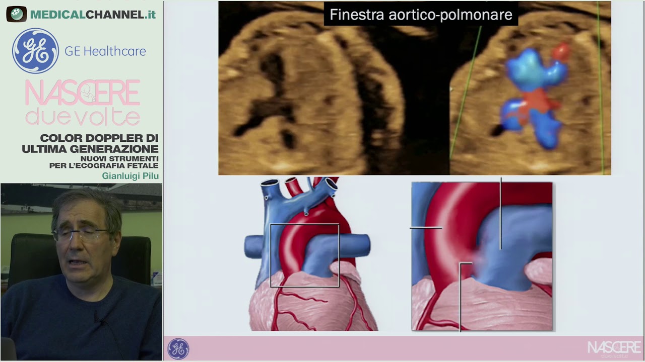 Nuovi strumenti per l’ecografia fetale - Color Doppler di ultima generazione