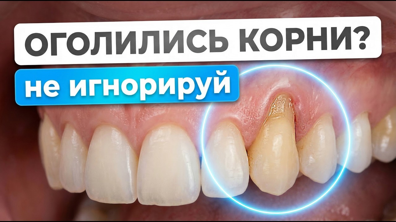 ОПУСТИЛАСЬ ДЕСНА? Вот что НУЖНО СДЕЛАТЬ/Стоматология Маэстро Улыбок
