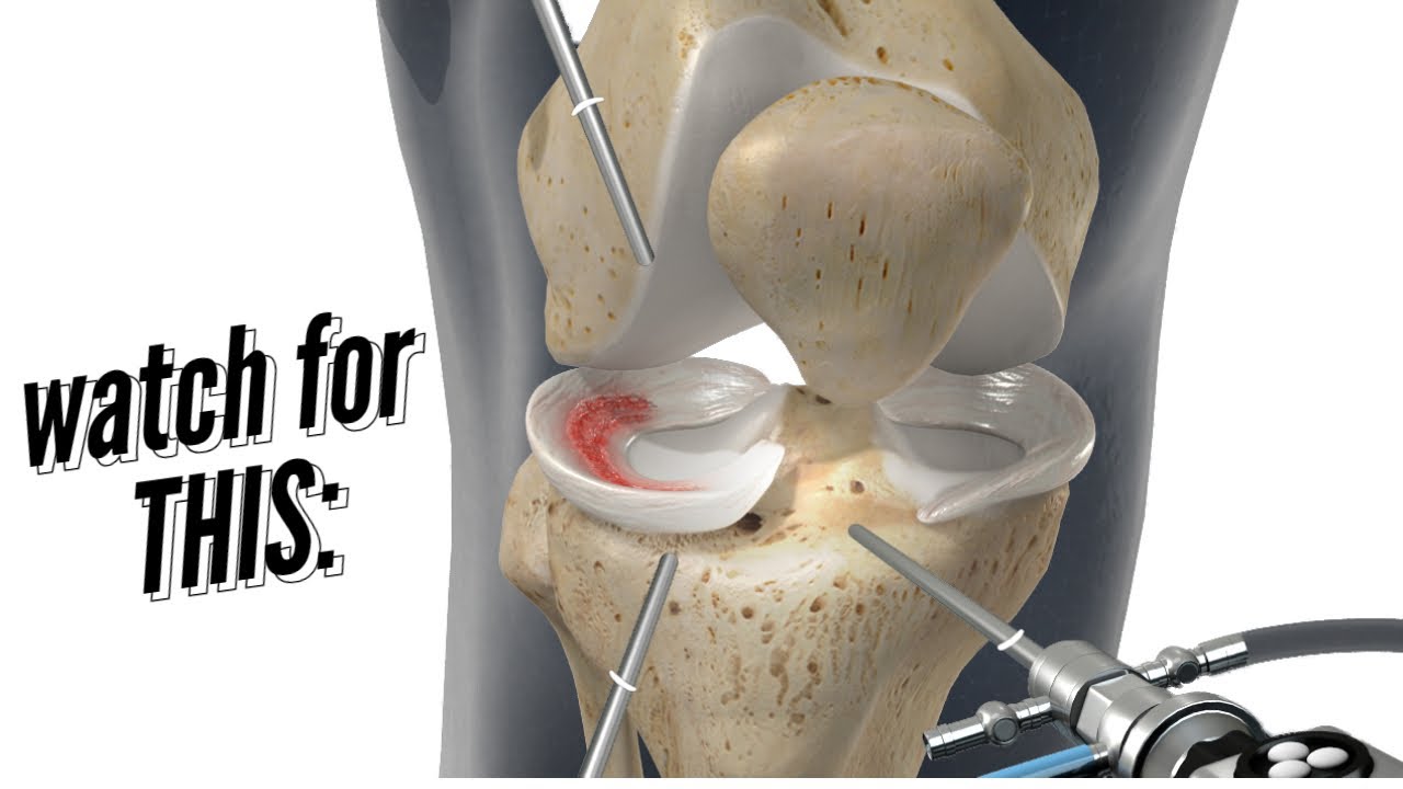 Meniscus Repair vs Meniscectomy