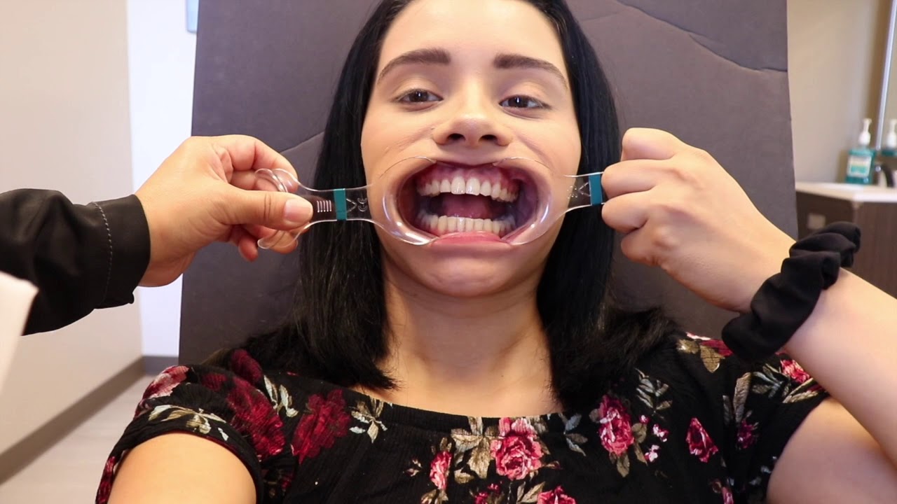 INVISALIGN: EVALUATING AND SCANNING TEETH FOR INVISALIGN TRAYS (RE- SCANNING AGAIN) NOT DONE YET