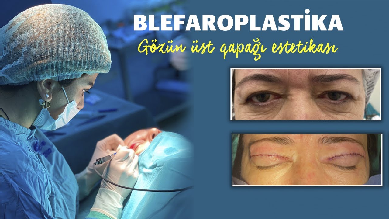 Blefaroplastika əməliyyatı - gözün üst qapağı estetikası