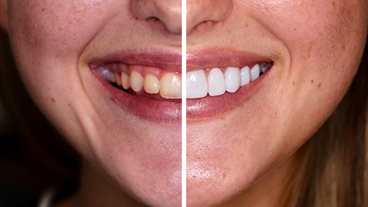 Composite vs Porcelain Veneers (San Antonio Dentist Reveals Winner)