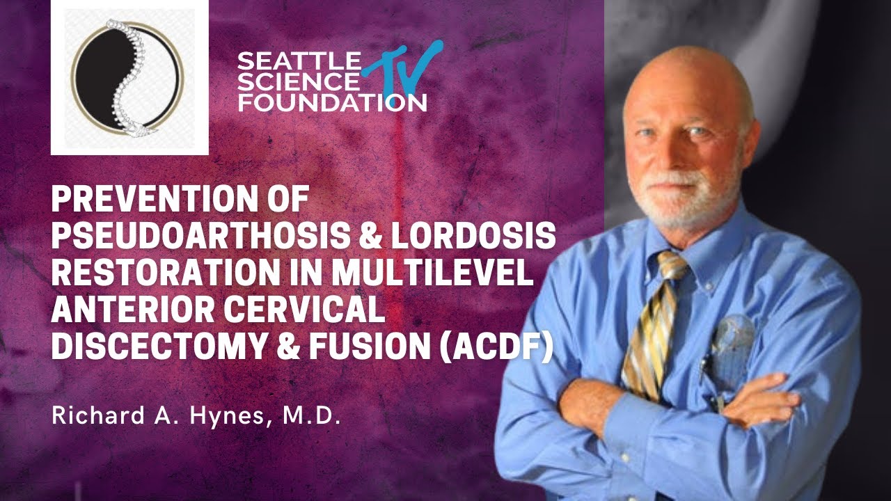 Prevention of Pseudoarthosis & Lordosis Restoration in Multilevel Anterior Cervical Discectomy