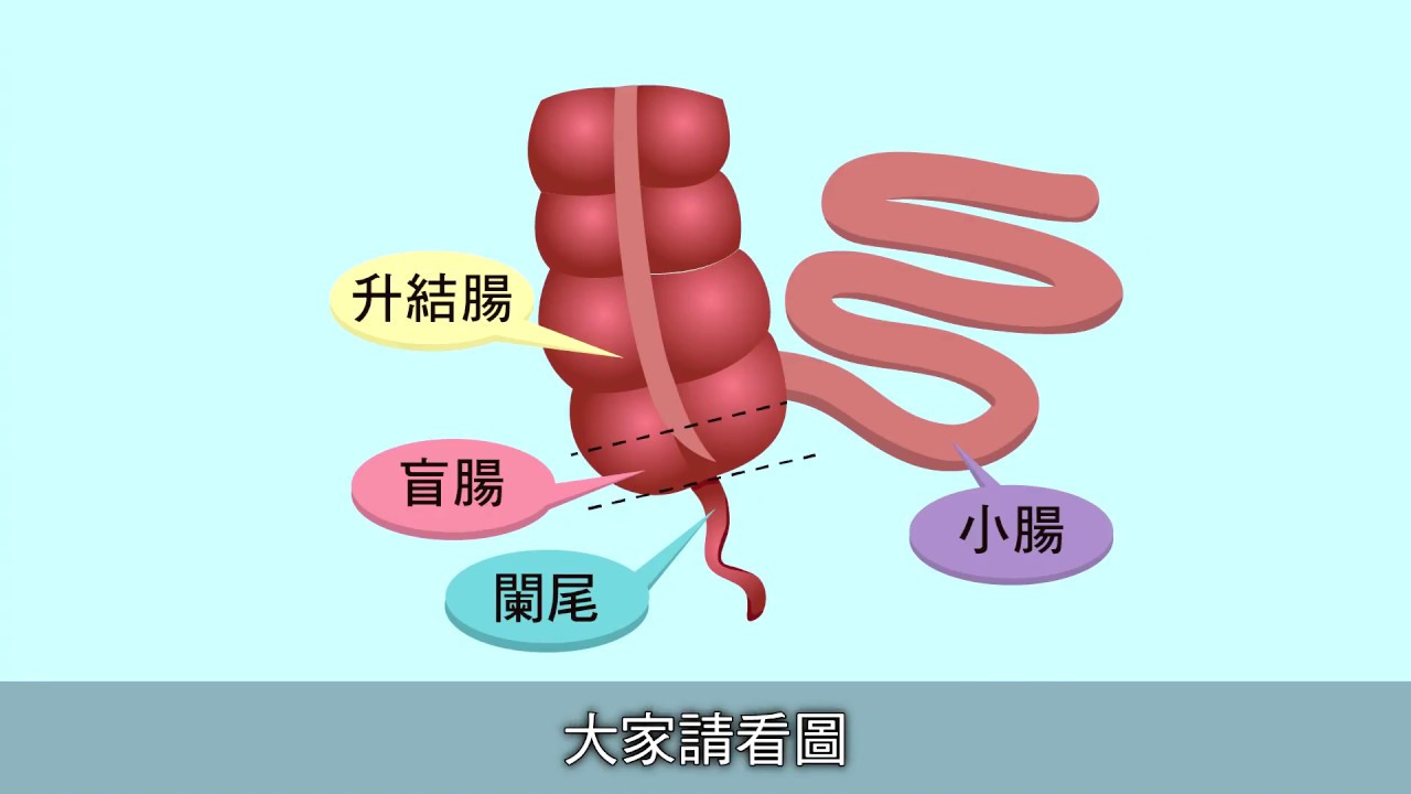 【醫師聊天室】為什麼闌尾會發炎？