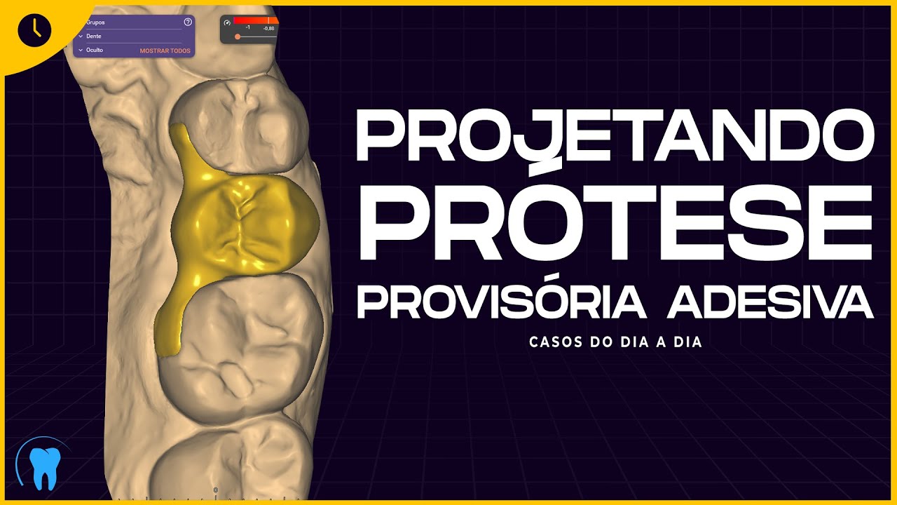 EXOCAD : Prótese Provisória Adesiva