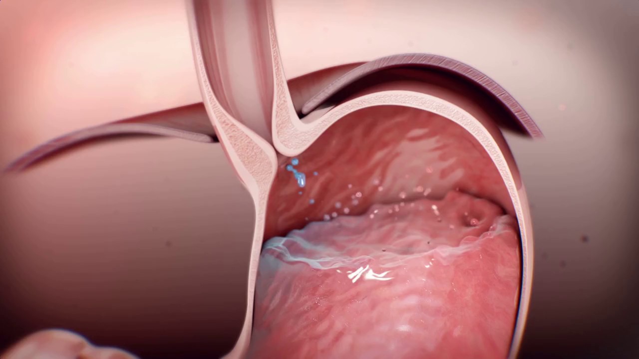 Sameer Islam What Can I Do About My Heartburn?