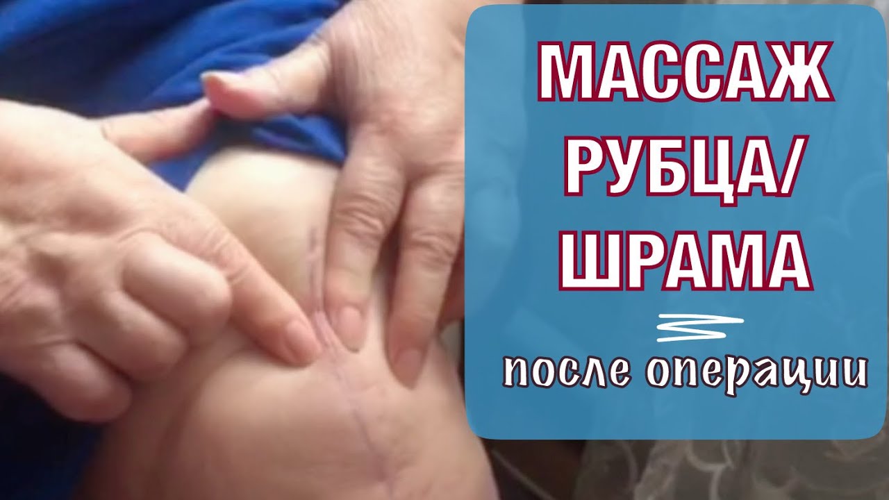 Массаж рубца/ шрама после операци. Self- Massage of the Scar after Surgery (English subtitles).