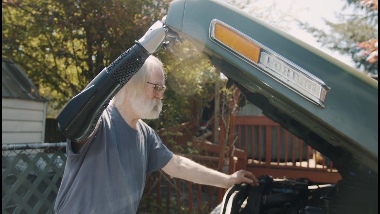 Meet Bruce and His Bionic Arm