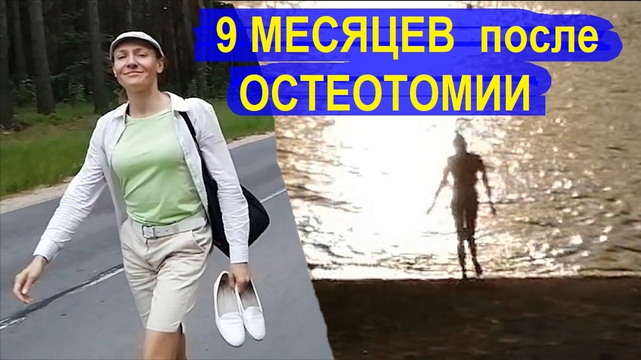 9 месяцев после ОСТЕОТОМИИ: море, солнце, пляж. // Мои успехи, состояние, походка, ограничения.
