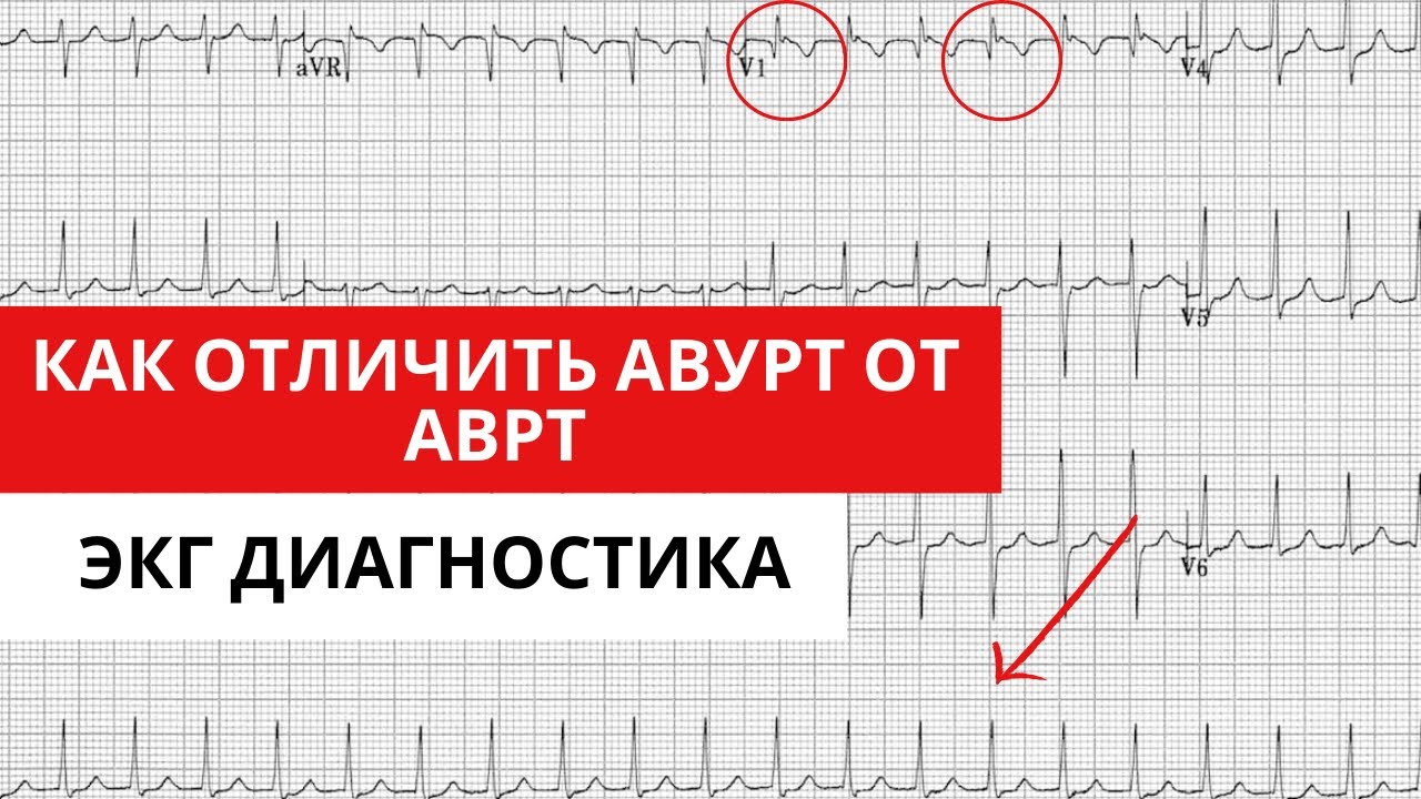 Наджелудочковые тахикардии. Как отличить АВУРТ от АВРТ. ЭКГ диагностика.