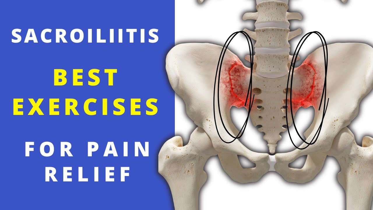 What is sacroilitis and what is the best exercises for pain relief