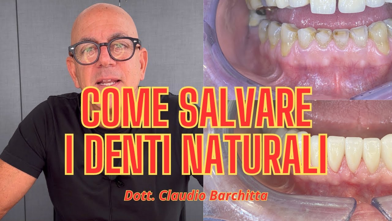 COME SALVARE I DENTI NATURALI - Dott Claudio Barchitta