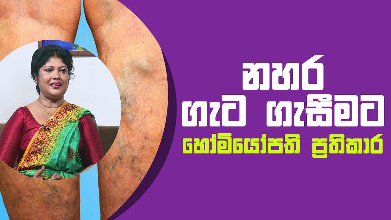 නහර ගැට ගැසීමට හෝමියෝපති ප්‍රතිකාර | Piyum Vila | 29 - 04 - 2021 | SiyathaTV