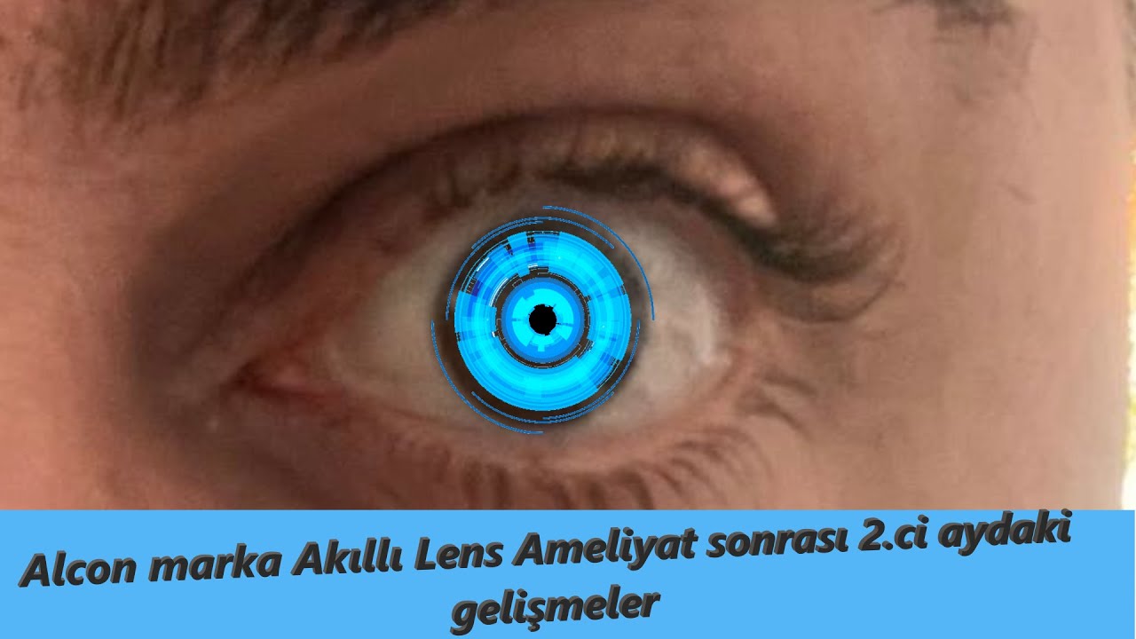 Alcon Akıllı Lens Sonrası 2 Ayda Gördüğüm Şaşırtıcı Gelişmeler! 👀