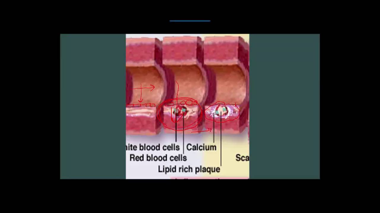 The coronary artery calcium story