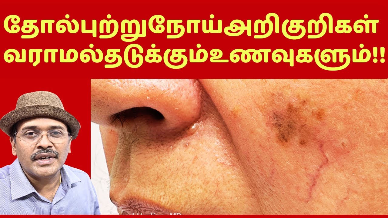 தோல் புற்றுநோய் அறிகுறிகளும் உணவுகளும்! | skin cancer symptoms foods treatment!