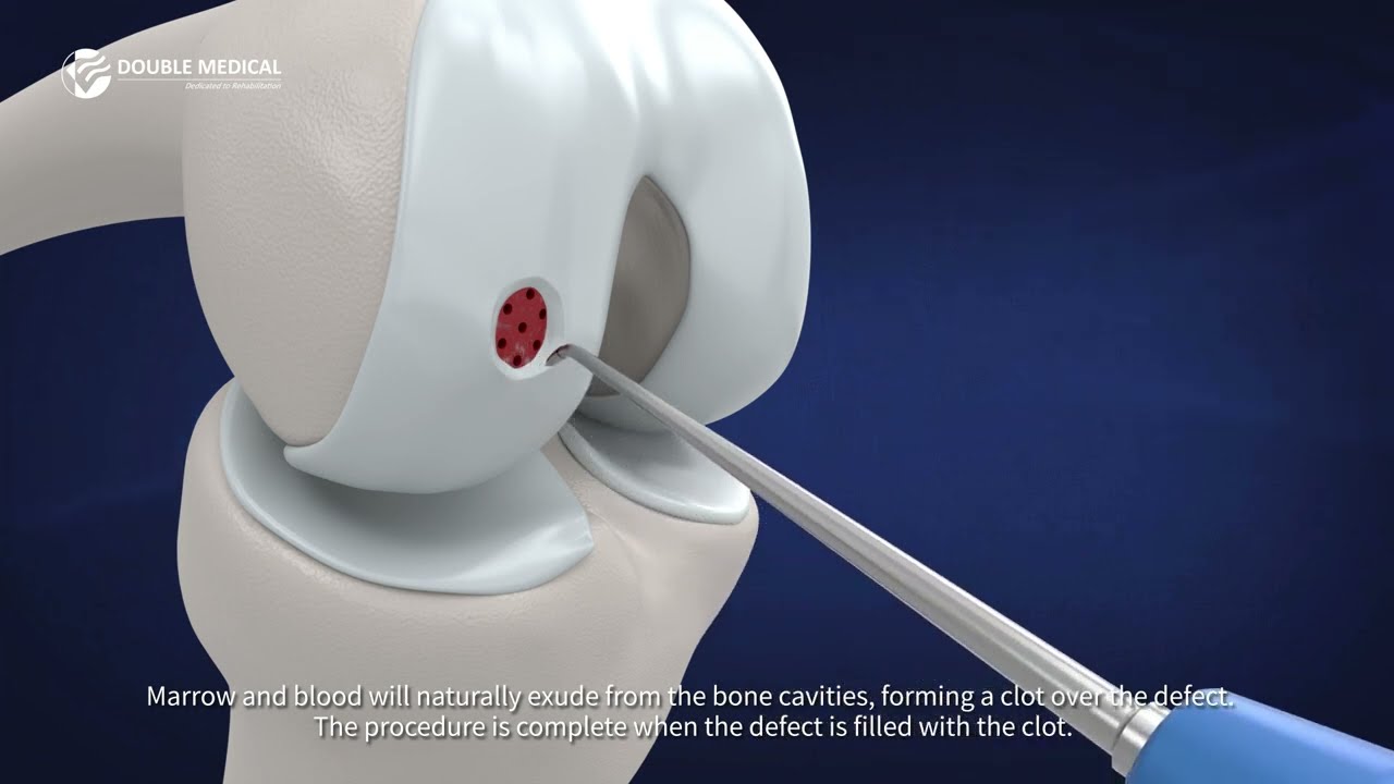 Precision Cartilage Repair Starts Here | Microfracture Instrument System
