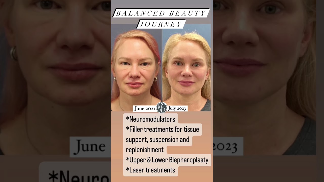 Natural looking results over time
