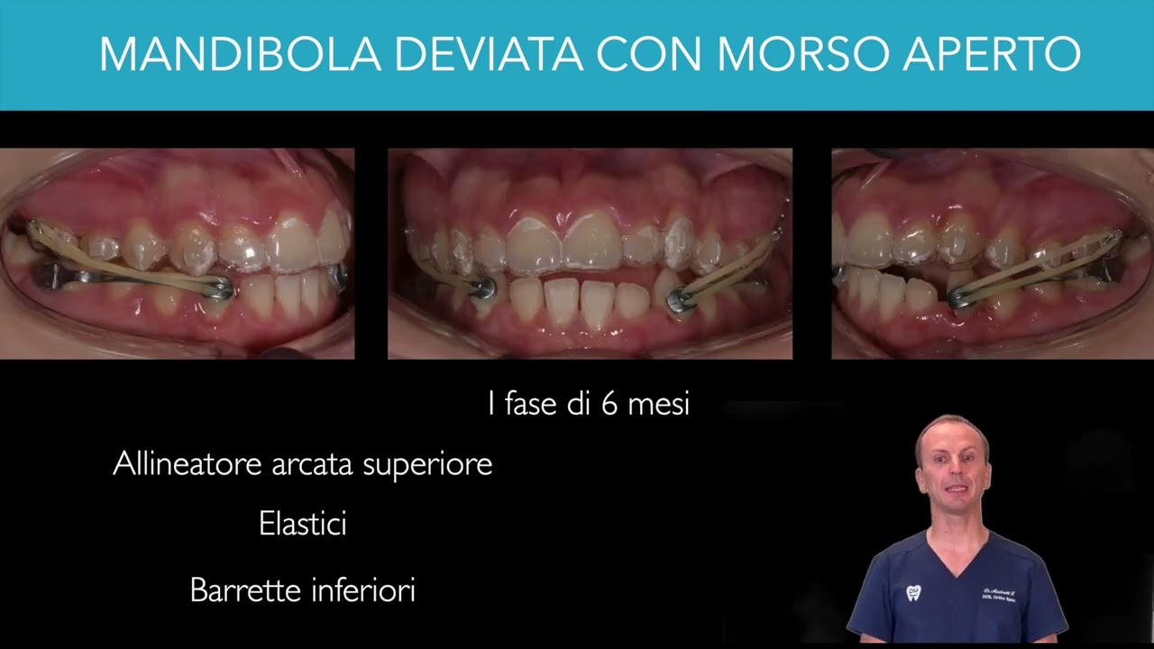 Correzione del morso aperto con allineatori trasparenti - prima e dopo