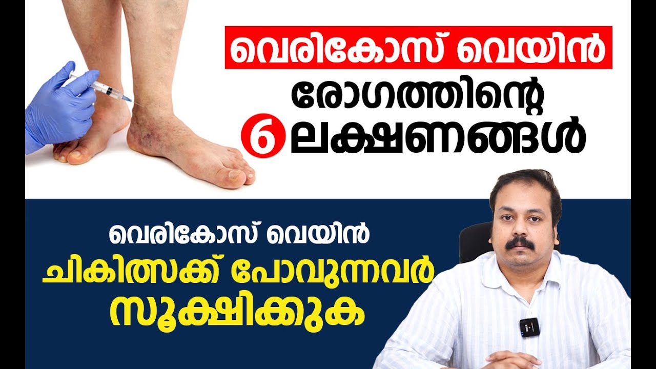 വെരികോസ് വെയിൻ രോഗത്തിന്റെ 6 ലക്ഷണങ്ങൾ | Varicose veins Malayalam Video