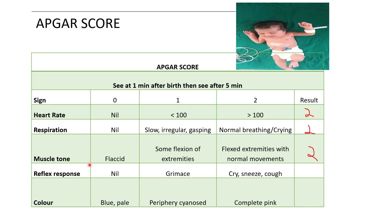 APGAR Score | Pediatrics
