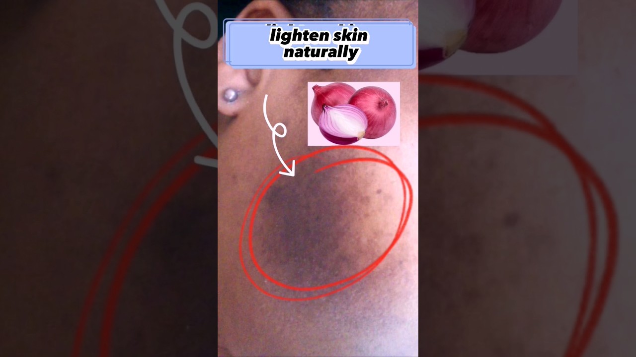 How to Lighten Dark Spots with Onions #shorts #Darkspots #remedy