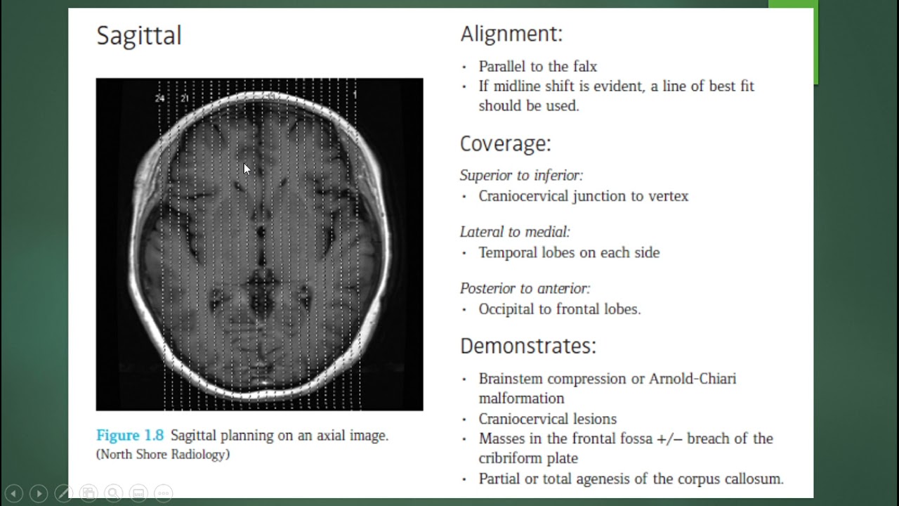 RM PROTOCOLO CEREBRAL GENERAL Y ACV