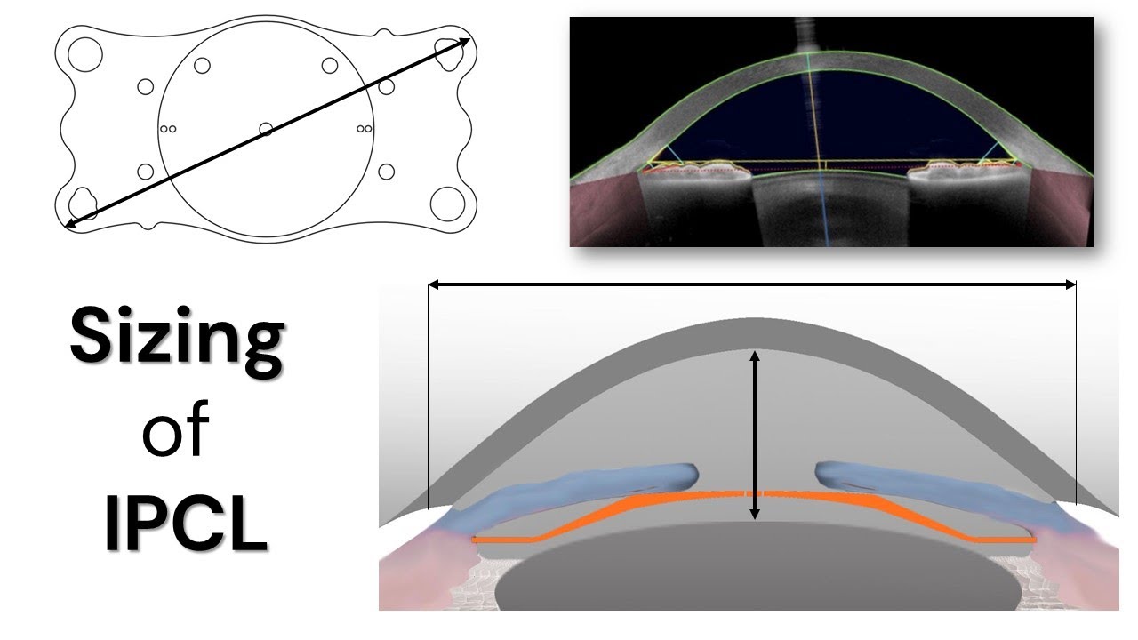 IPCL Sizing: wtw, ACD, vault and beyond.