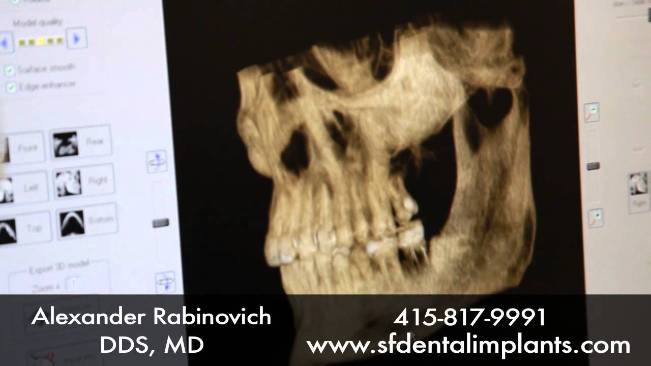 Understand Dental Implants: Overview to Dental Implant Surgery
