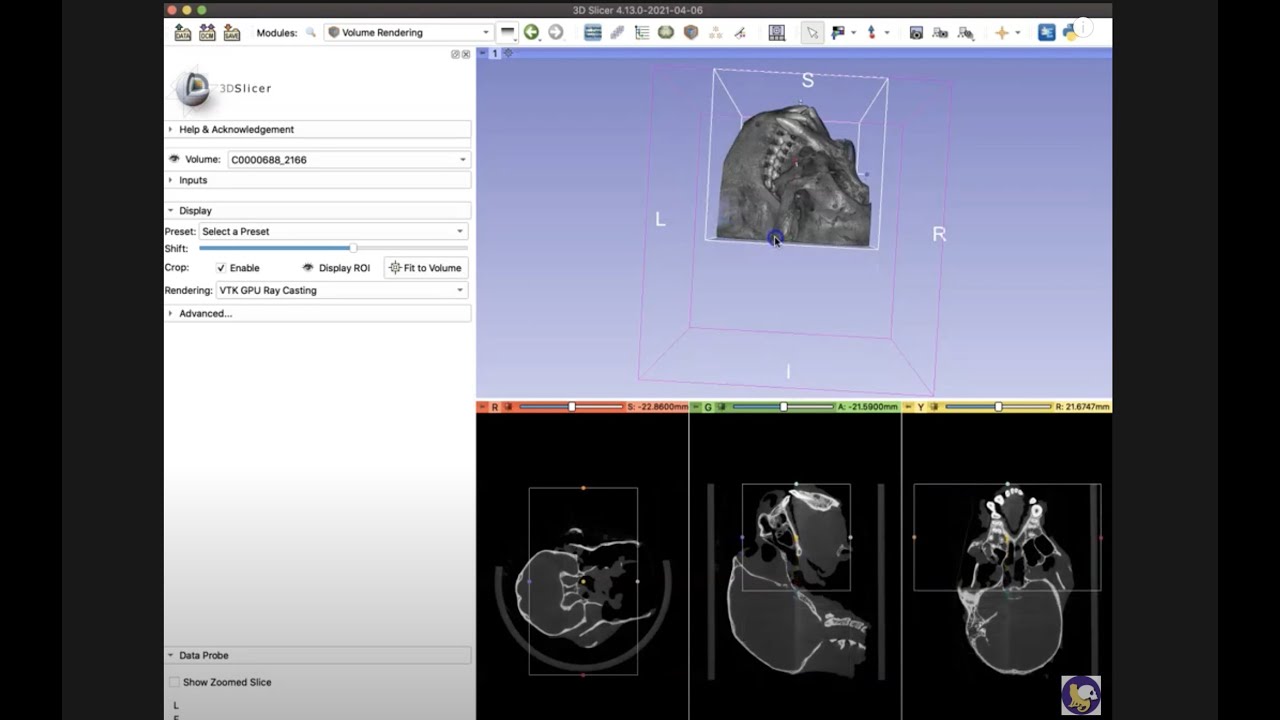 Cropping a Volume   [3D Slicer Workflow]