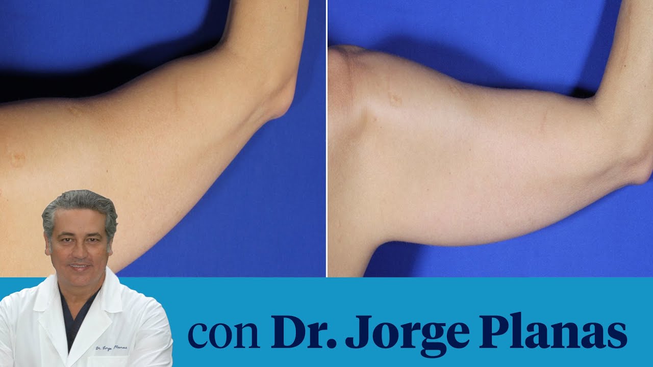 Cómo se hace un lifting de brazos